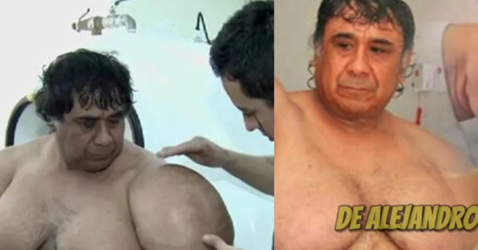 Este hombre quedo inflado debido a esta condición; era buzo anteriormente